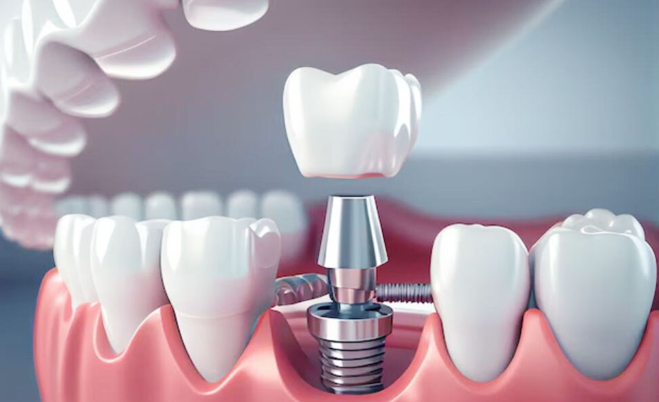 ¿Cuáles son los componentes de los implantes dentales?